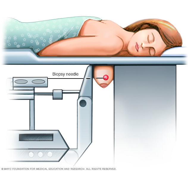 Stereotactic breast biopsy