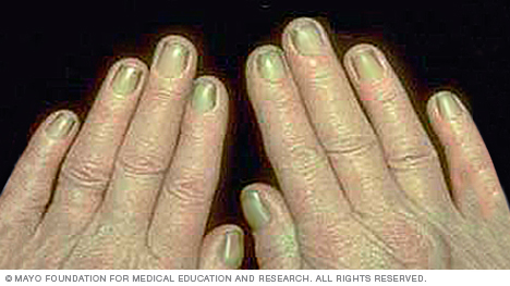 An example of yellow nail syndrome