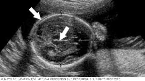 Ultrasound image showing a fetus's head