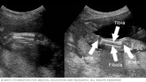 Ultrasound image showing a fetus's lower legs