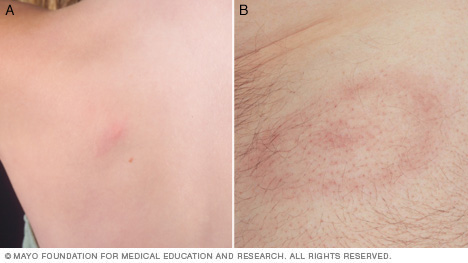 An example of Lyme disease rash