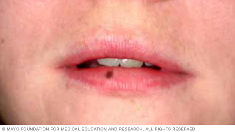 Example of labial lentigo