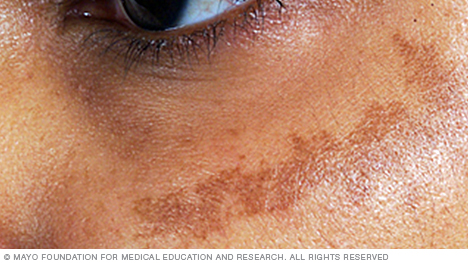 Example of melasma