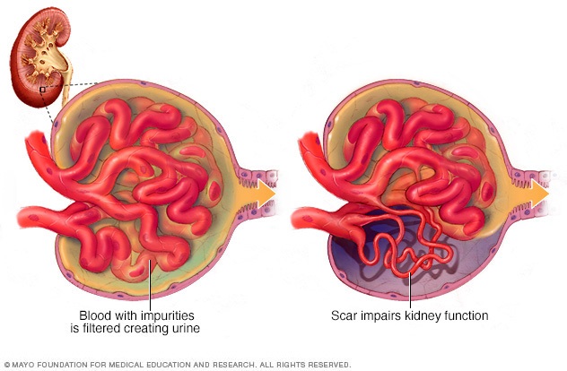 Glomeruli in the kidneys showing a typical glomerulus and a scarred glomerulus