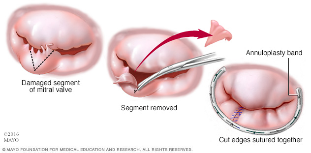 Mitral valve repair