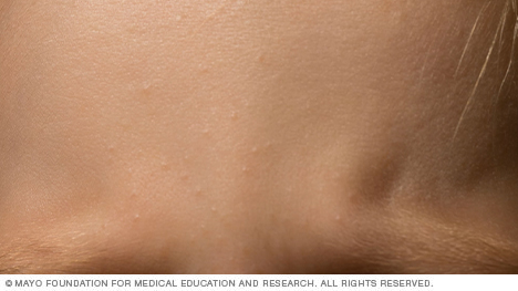 Small bumps on a newborn baby's face