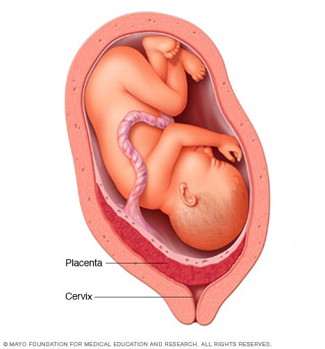 Placement of placenta and placenta previa