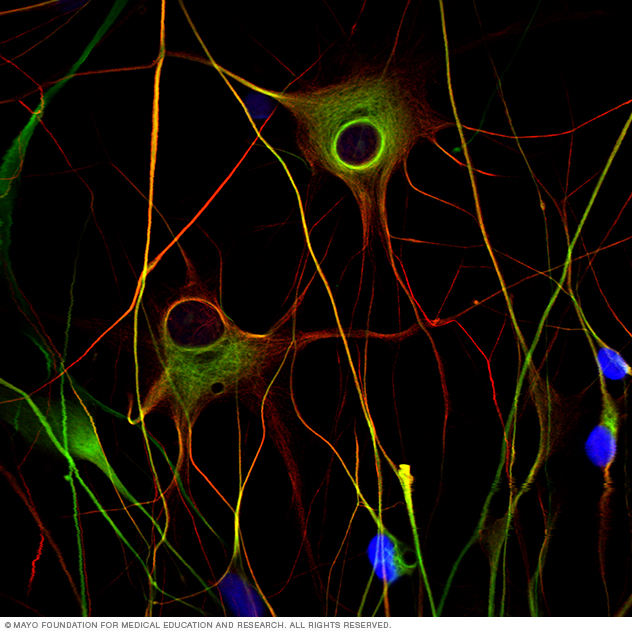 Malignant glioma cells