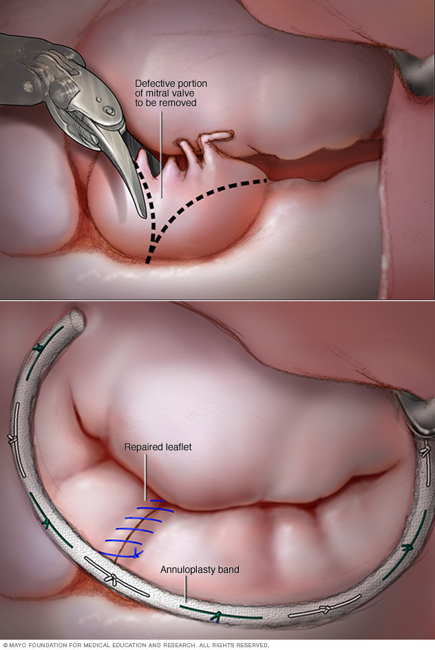 Robotic mitral valve repair