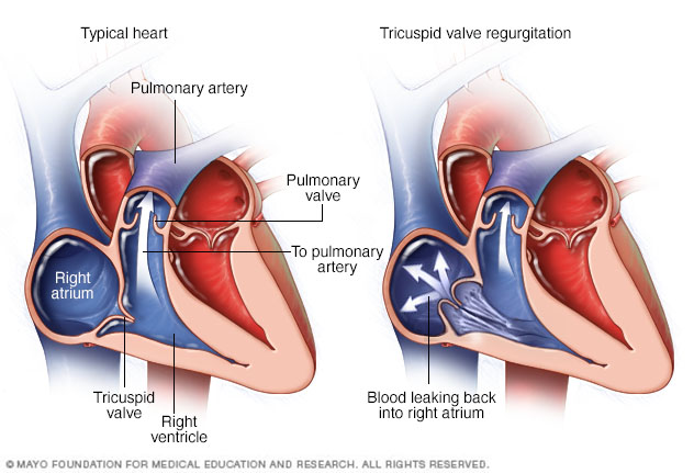 Tricuspid valve regurgitation