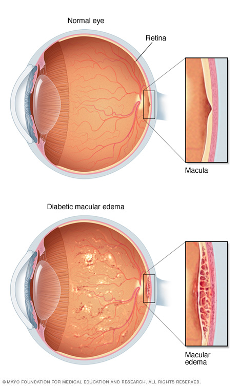 Diabetic macular edema