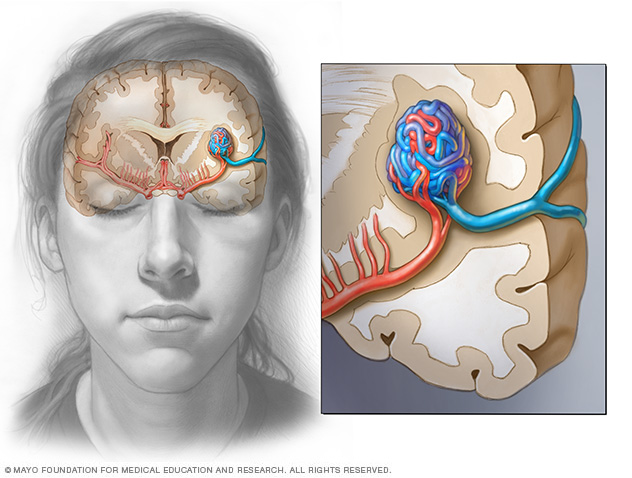 A brain AVM