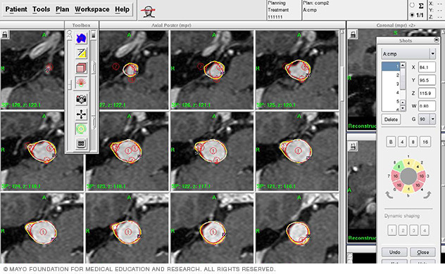 Computerized stereotactic radiosurgery radiation dose planning