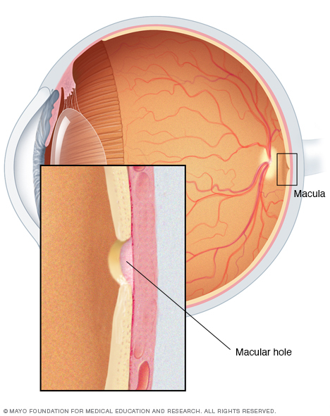 Illustration of macular hole