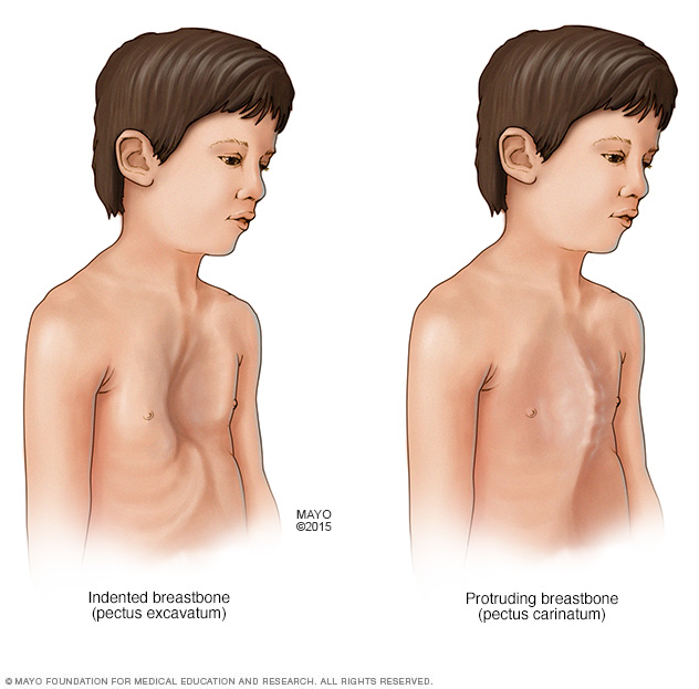 Chest abnormalities