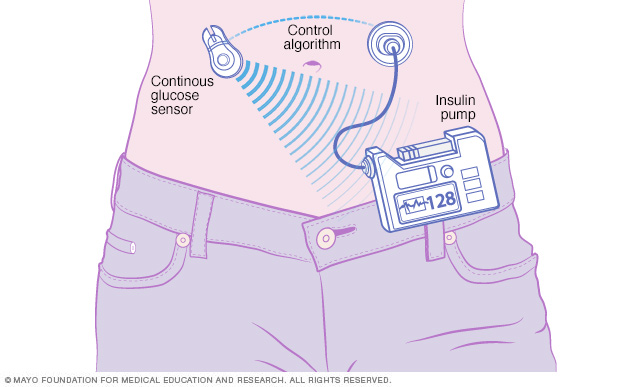 Artificial pancreas