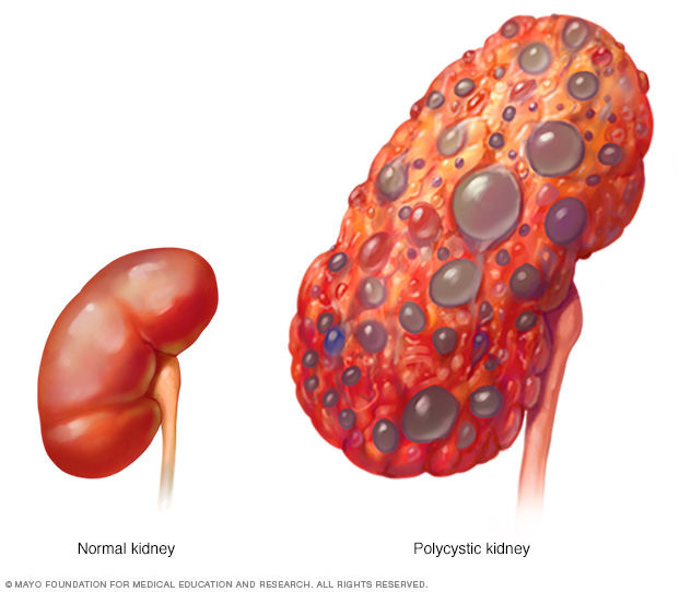 Polycystic kidney compared with normal kidney