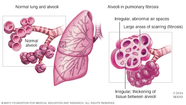 Pulmonary fibrosis