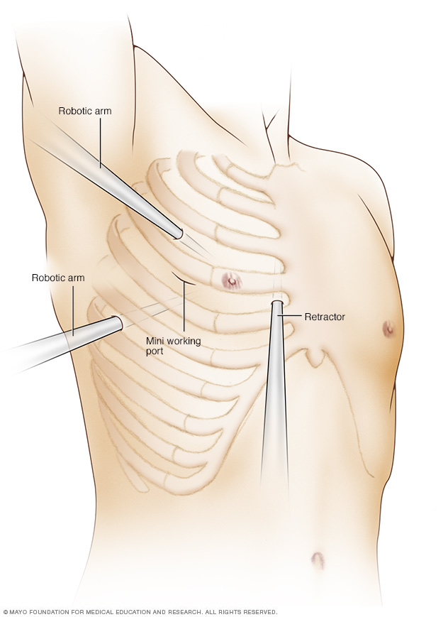 Incision sites in robot-assisted heart surgery