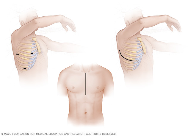 Incisions in minimally invasive and open-heart surgery