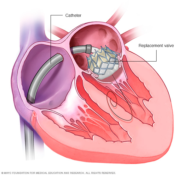 Minimally invasive heart surgery