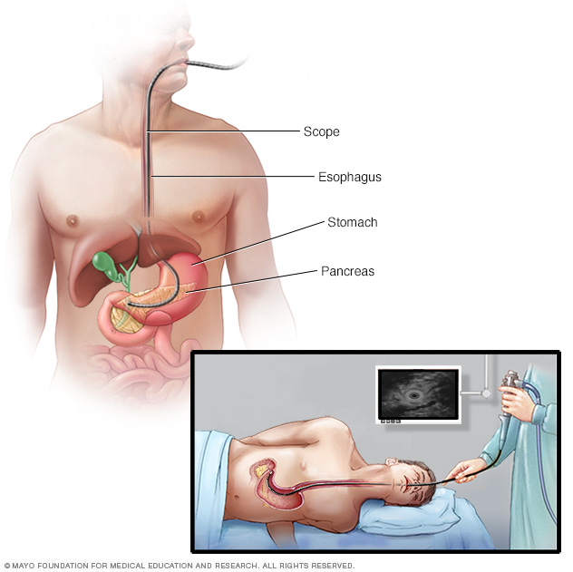 Ultrasound device being threaded through an endoscope into the abdomen