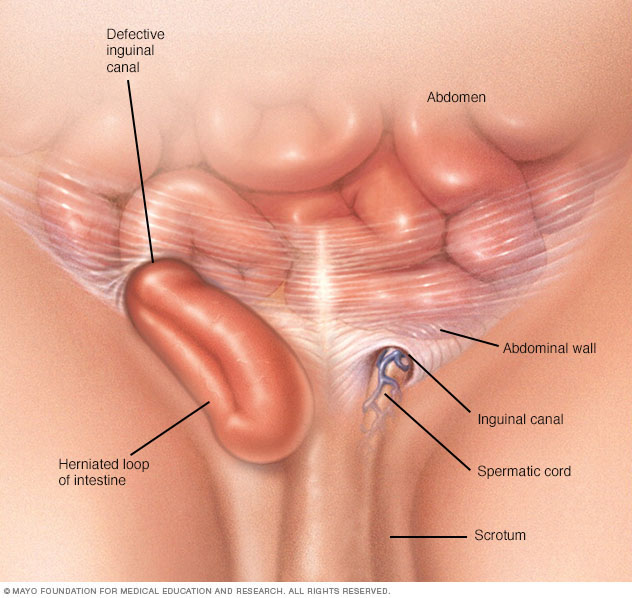 Inguinal hernia