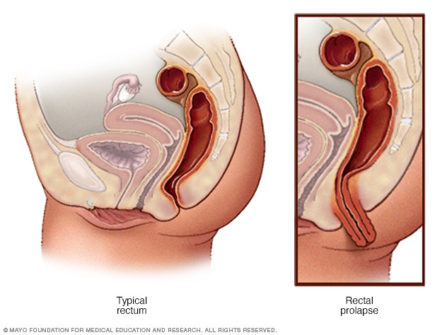 Normal rectum and rectal prolapse