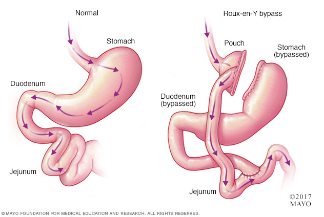 Gastric bypass surgery