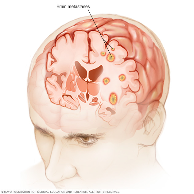 Brain metastases