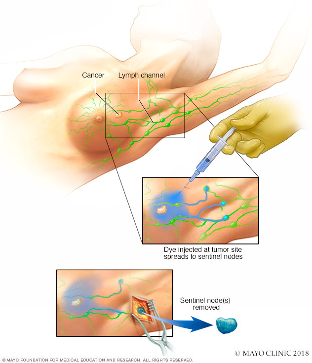 Sentinel node biopsy