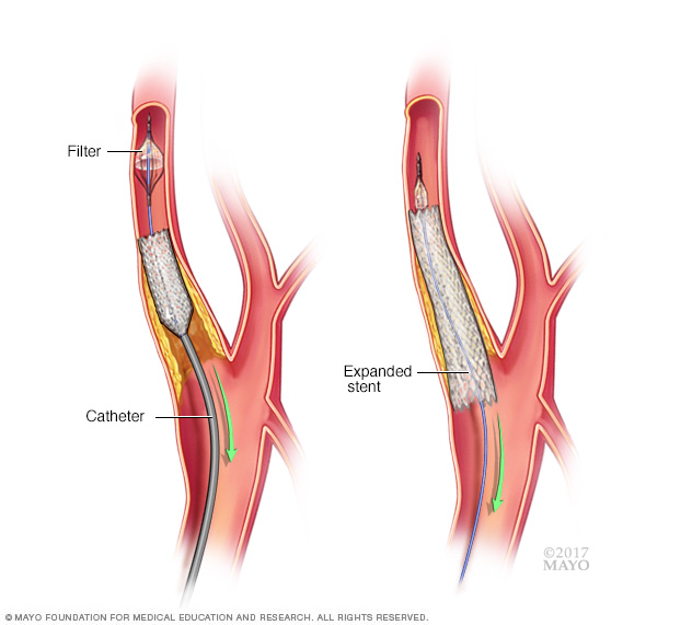 Carotid stenting