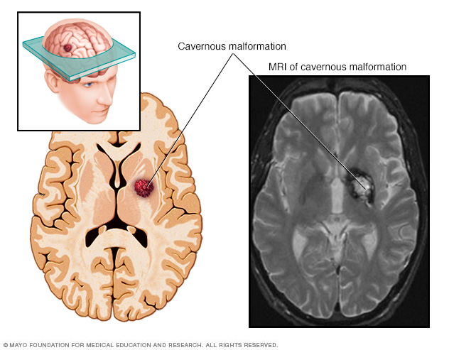 Brain aneurysm