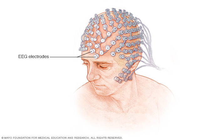 Electrode placement in high-density EEG testing