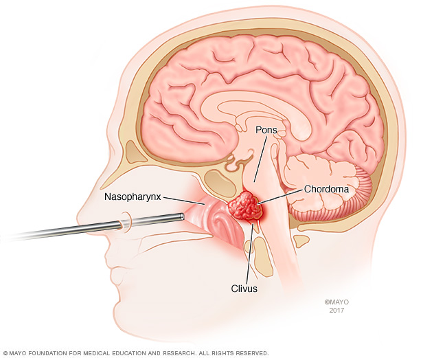 Endoscope inserted through nose to access skull base chordoma