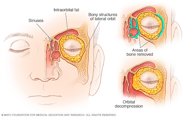 Before and after illustrations of surgery to relieve pressure behind the eye