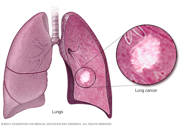 Lung cancer