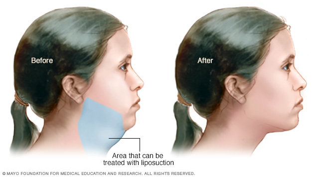 Area under chin that can be treated with liposuction