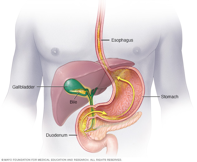 Bile reflux into the stomach and esophagus