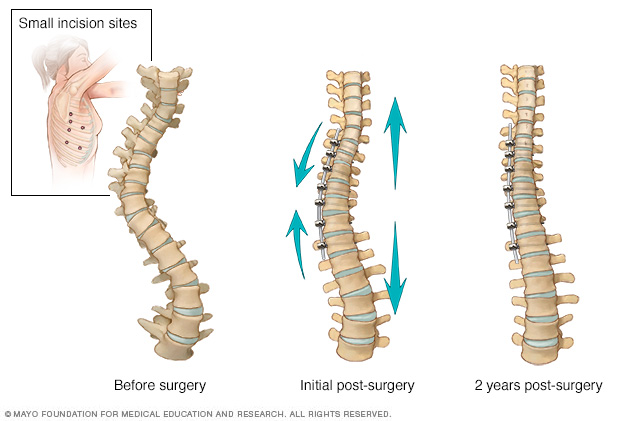 Effects of vertebral body tethering