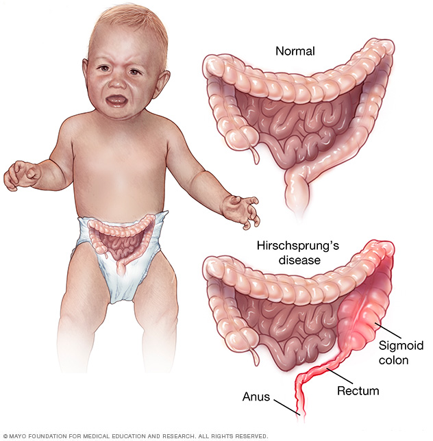 Illustration showing normal colon and rectum and with Hirschsprung's disease