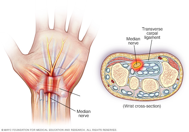 Image showing pinched nerve in wrist