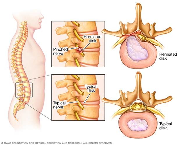 Image showing pinched nerve in spine