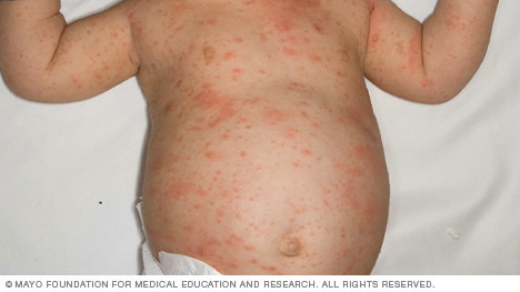 Photo of heat rash