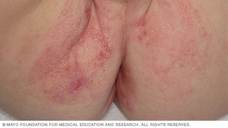 Photo of diaper rash