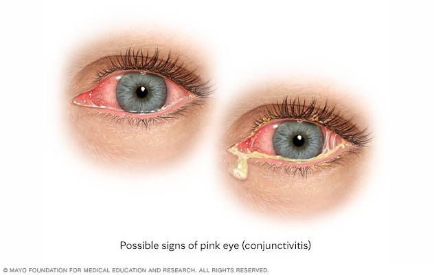 Pink eye (conjunctivitis)