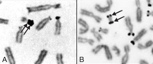 Representative nucleolar organizing region-banded partial metaphases illustrating double satellites and an isodicentric chromosome with satellites at both ends