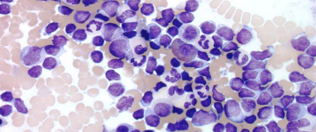 Chronic lymphocytic leukemia cells from bone marrow