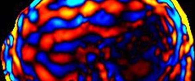 Magnetic resonance elastography image showing stiffness of the liver from the Advanced Magnetic Imaging Technology Lab at Mayo Clinic.