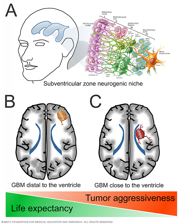 Diagram shows clinical interaction of glioblastoma and subventricular zone in the human brain.